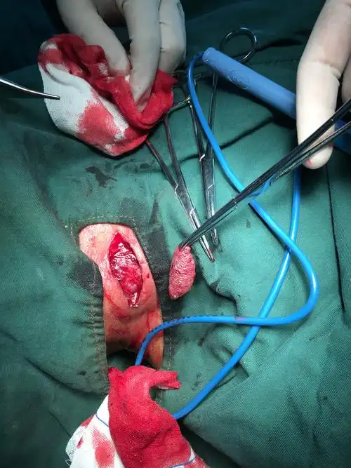 手术在局麻下进行,在肿物周围注入麻药,将肿物连同表面的皮肤一起切除