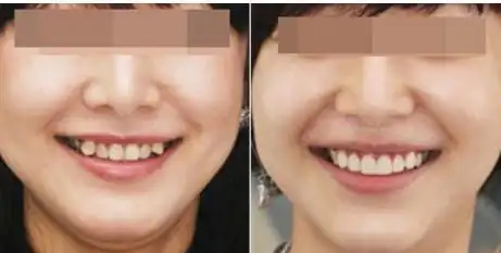 虎牙太过突出应该拔除还是矫正