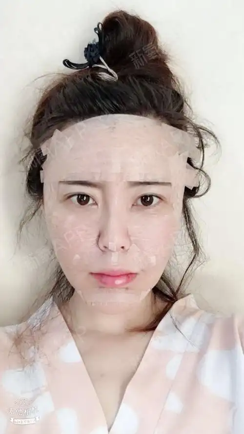 candy自体脂肪全脸填充第1天美丽日记