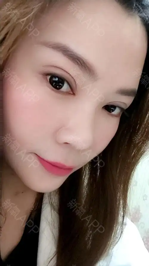 全切双眼皮第25天啦,眼部线条逐渐恢复自然啦,从手_圈子-新氧美容整形