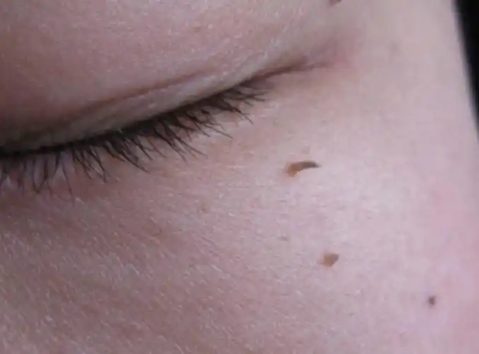 脖子上长小肉疣怎么去除(脖子上长小肉疣怎么去除用什么药)