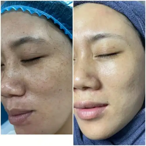 祛斑前后对比
