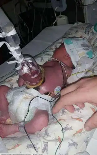 妈妈发现「胎儿肠子外露」坚持不肯堕胎,没想到8个月后.