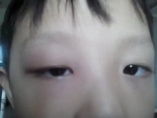 我弟的眼睛从早上一醒来就特别肿,眼睛明显变得很小,他说眼皮上特别痒