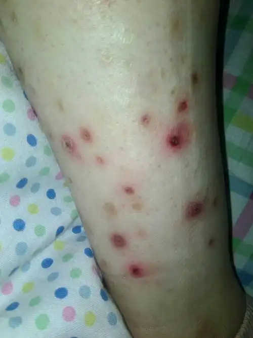 展开全部 方便的话可以发张局部照片,初步估计是毛囊炎  追答 这个不