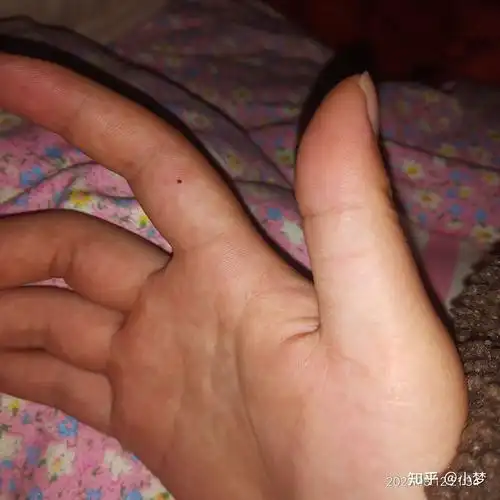 女生右手中指突然长了个小痣代表什麼? - 知乎