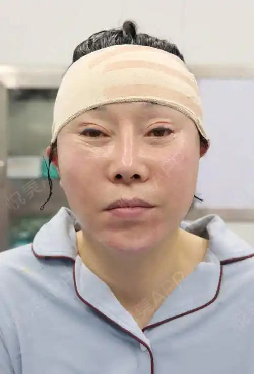 小切口手术提升术后1天_埋线提升术后1天_拉皮手术提升术后1天_紧致