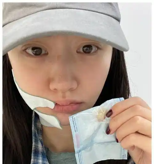 景甜拔牙脸肿到认不出,素颜出镜五官清秀_网友_照片_刚拔