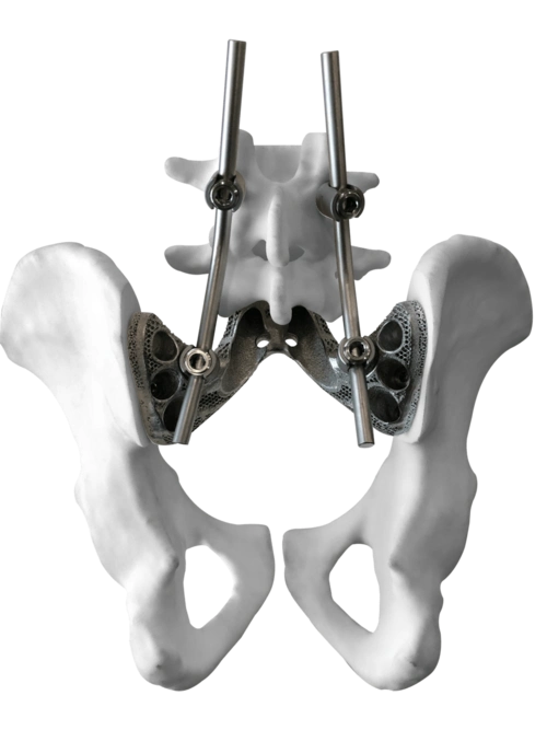 让骨肿瘤患者有尊严地站立中国3d打印钛合金组配式人工半骨盆假体实现