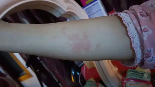 谁能帮我看一下这个属于皮肤过敏还是别的什么?