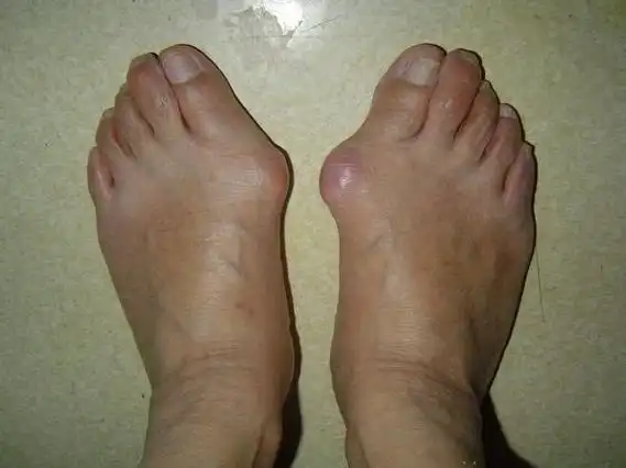 明显改观—重度拇外翻拇囊炎手术前后比较 - 好大夫在线