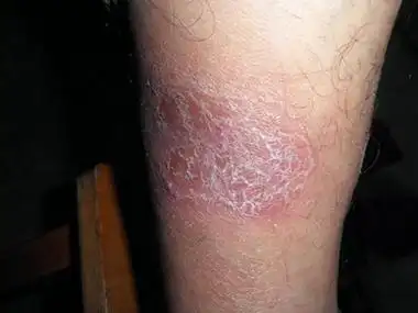 胰腺性脂膜炎小腿皮肤发红起皮图