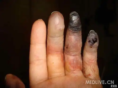 hs病例分析手指头坏疽