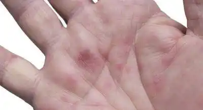 原创乙肝会转肝癌吗?医生提醒:身体出现两红两黄,要注意了!