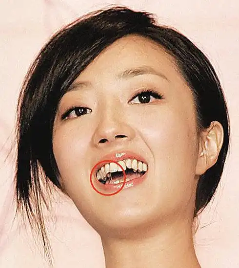 看看女明星的烂牙!