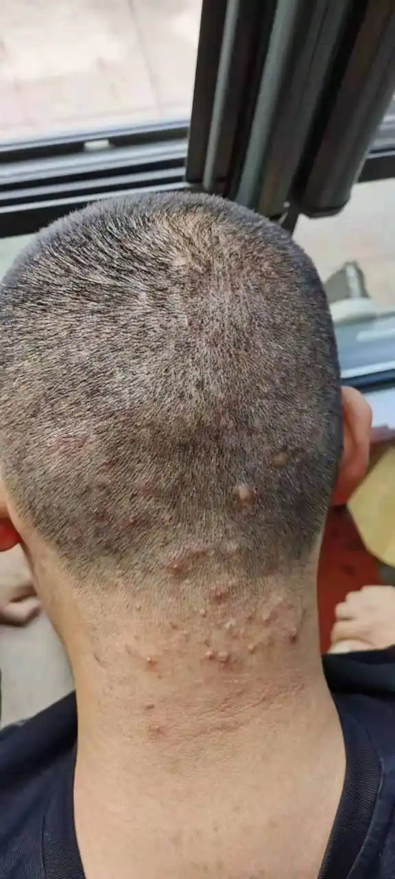 用中药可以吗? 【回答】很多毛囊炎患者