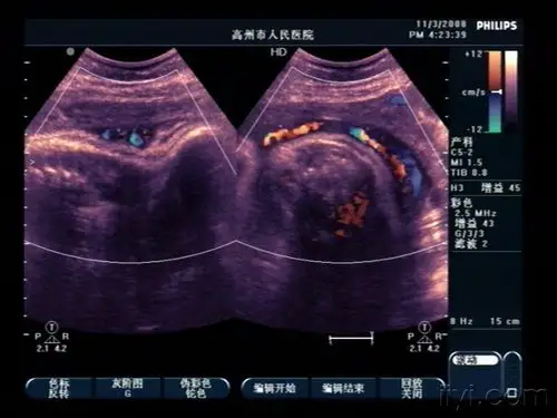典型脐带绕颈(2周) - 超声医学讨论版 - 爱爱医医学论坛