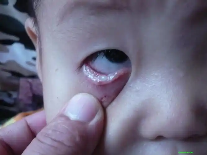 小儿睑缘溃疡,伴有全身皮肤粘膜病变