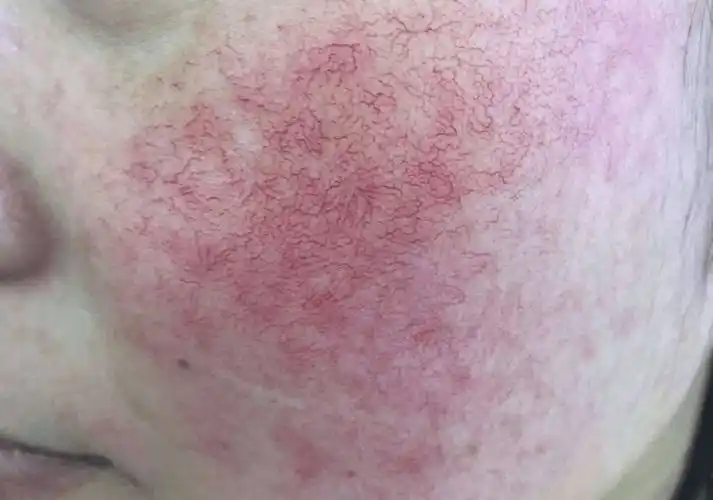 脸上突然长红血丝怎么办?