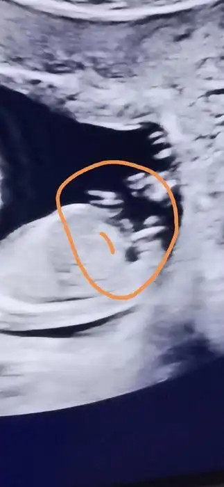 今天刚做的nt,有经验的宝妈猜一猜,男宝还是女宝?