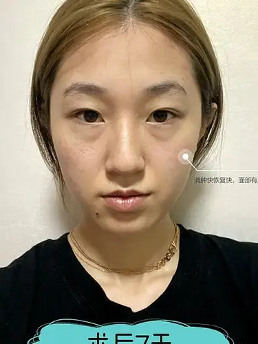 今天我们来分享一下自体脂肪面部填充的案例,让我们一起看看这位求美