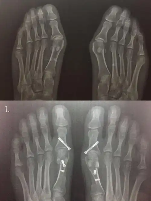 脚骨x光片术前术后对比在油管上查了很多关于拇外翻手术的视频(血腥