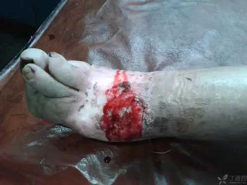 【求教】下肢齿轮碾压伤后萎缩,畸形,皮肤大面积溃烂,发臭20年余.