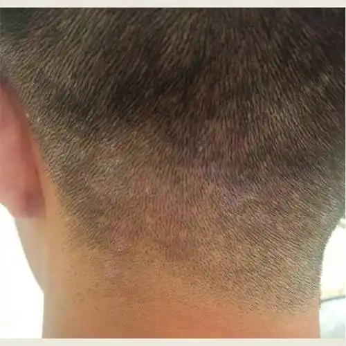 头上毛囊炎用什么洗发水?控油去屑洗发水排行_头皮_成分_症状