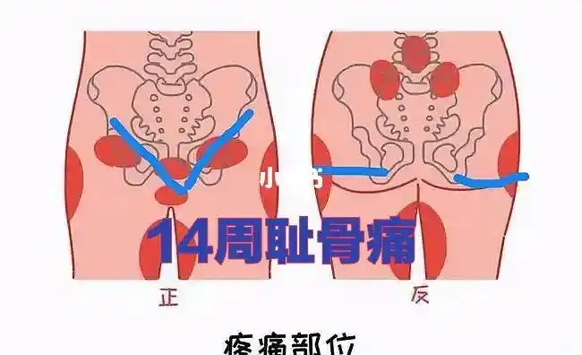 14周耻骨痛到难以入睡