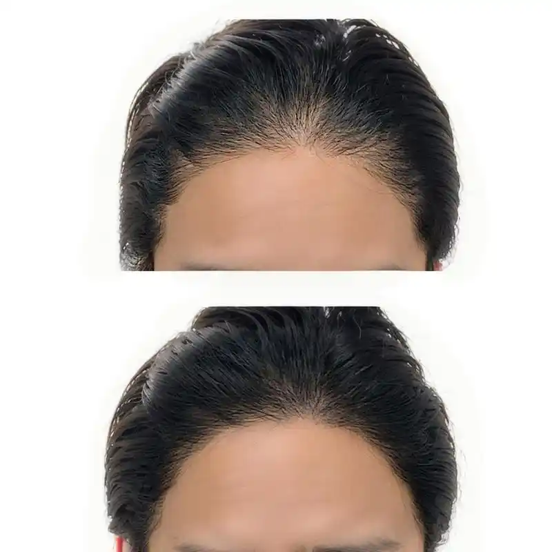 要纹绣出好看的发际线,首先要选择经验丰富的专业人士.