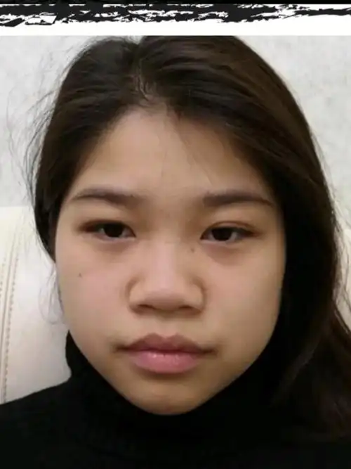 没有鼻尖的鼻子图片鼻头大鼻翼宽鼻翼肥厚宽鼻翼图片大鼻头宽鼻翼鼻子