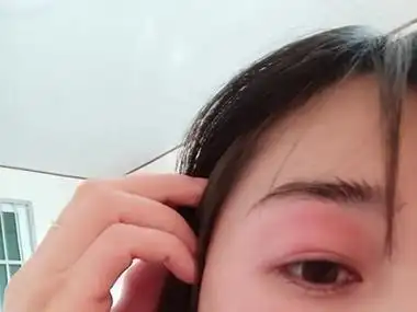 过敏性眼睑皮肤炎上眼睑大面积发红图.jpg