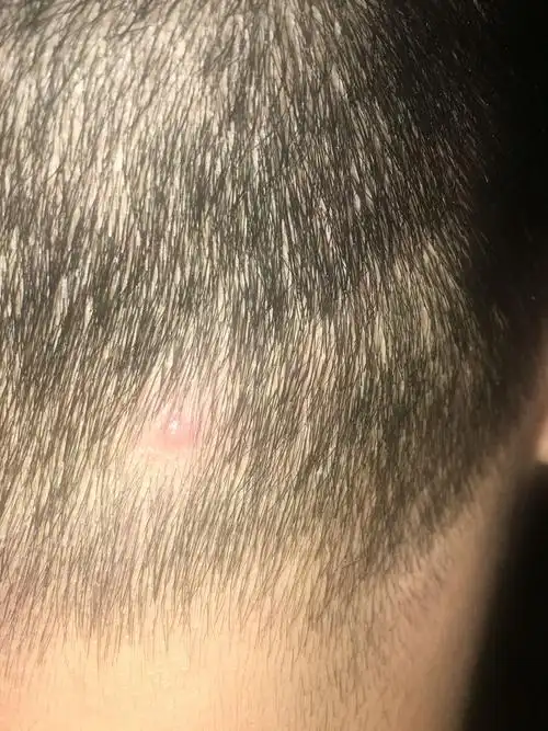 头上起了个痘,一直也不消,有人说时毛囊炎,帮忙姥姥是不是,擦什么最