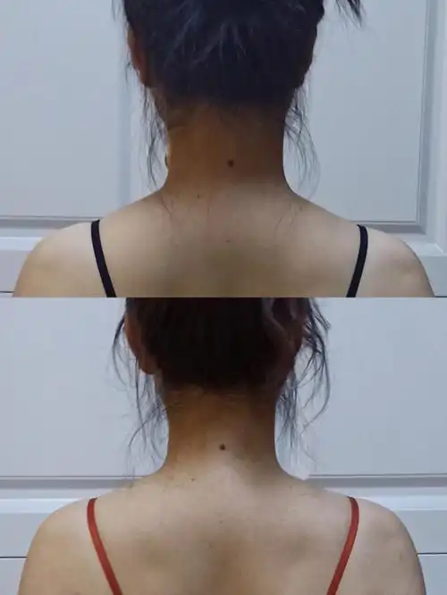 我的斜方肌有救了