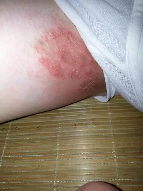 我大腿内侧红的,有点疼,还有一些白色小点,不知道是股癣还是什么病