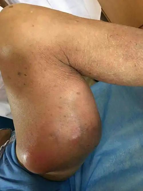 区外科团队独立顺利完成一例高难度高龄病人左大腿巨大恶性肉瘤切除术