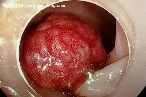 人体痔疮长什么样子的图片在哪个位置,内痔在齿状线以上会出血 — 神