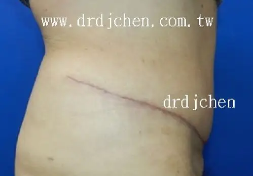 整形手术 | 腹部拉皮手术