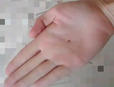 处于手掌正中区域的痣是大吉大运痣,越正中越好,正是因为很少有拥有