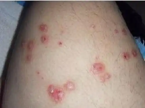 血热引起的皮肤病由血热引起的皮肤病