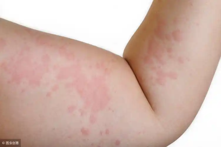 皮肤过敏要怎么办才好?