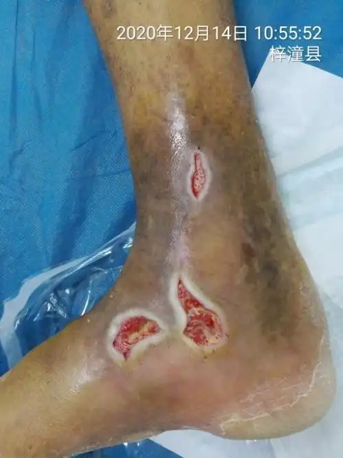 合并钙化防御的糖尿病难愈性皮肤破溃的愈合历程 - 美篇