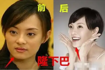 右侧是垫下巴整容之后的照片三,孙俪隆下巴以前的孙俪鼻头很圆,如今明