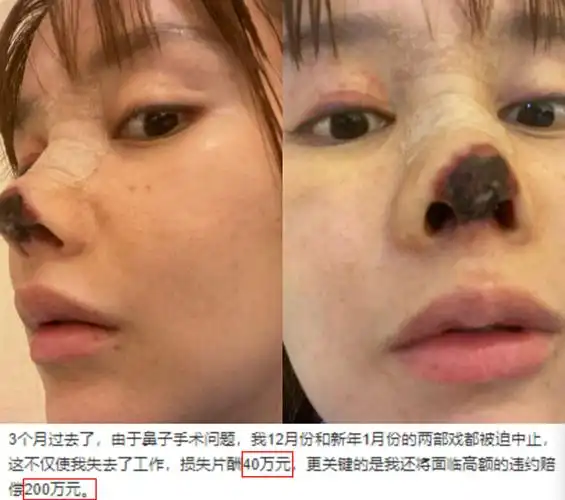 演员高溜整容失败后首现身摘口罩露出整张脸鼻翼缺损鼻尖红肿