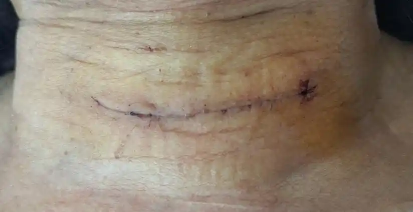 太原市中心医院汾东院区肝胆外科顺利完成首例甲状腺手术