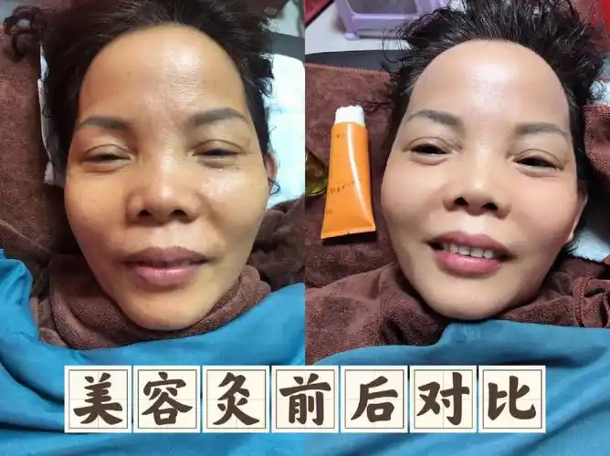 [福]今日帮师兄做脸部美容,未做之前,脸色腊黄,腊黄的,正宗黄脸婆一个