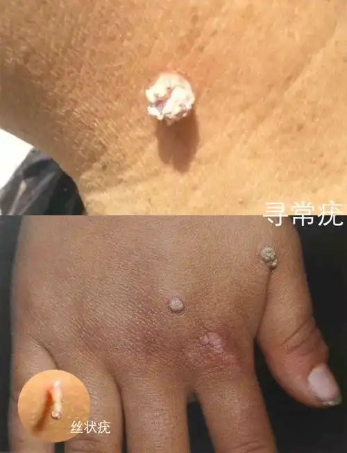 寻常疣中还有一种特殊的"丝状疣",其好发于颈部,额头,眼睑(即眼皮)等
