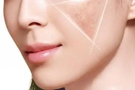 做皮秒会使皮肤变成敏感肌吗?