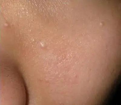 脂肪粒好像灾难般蔓延在脸上,你拿什么来预防?