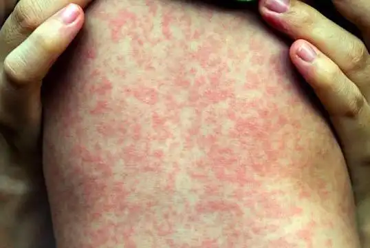 西悉尼又有1人感染麻疹 新州确诊病例已达22例